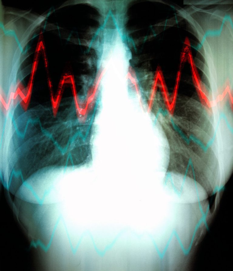 X-ray of lungs