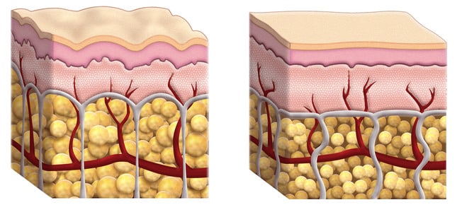 photodune-3082615-cellulite-cross-section-xs